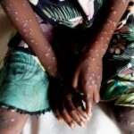 CABINDA CONFIRMA CINCO INFEÇÕES POR MPOX ENTRE 20 CASOS SUSPEITOS