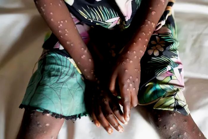 CABINDA CONFIRMA CINCO INFEÇÕES POR MPOX ENTRE 20 CASOS SUSPEITOS